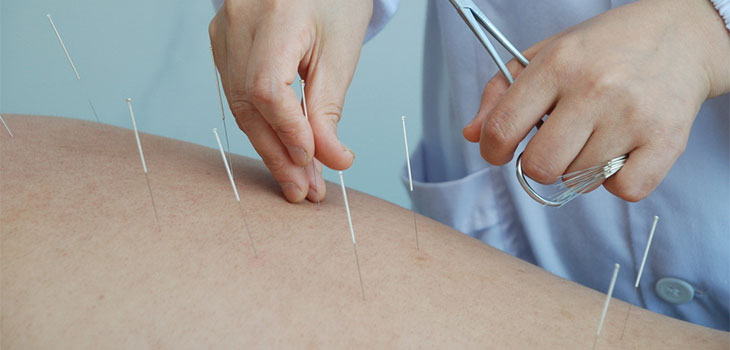 Acupuncture and Moxibustion